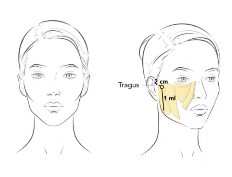 profhilo structura injection visage creusé